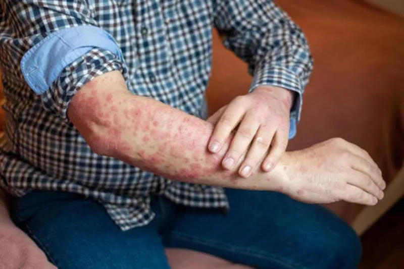 Niños y adultos mayores son los principales afectados por el sarampión/Pixabay