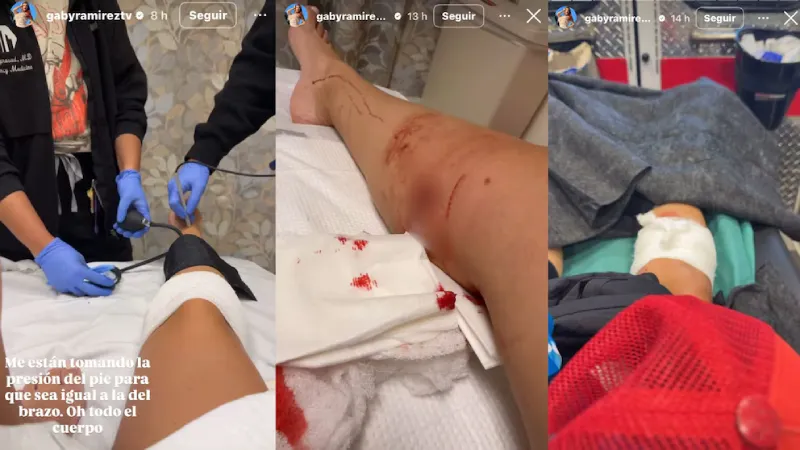 Los médicos dijeron que por fortuna la mordida no llegó al hueso / IG: @gabyramireztv