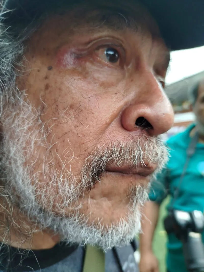 El periodista Sergio Ocampo quedó lesionado cerca del ojo derecho / Redes Sociales