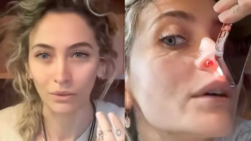 Por la droga se perforó el tabique de su nariz / Redes Sociales