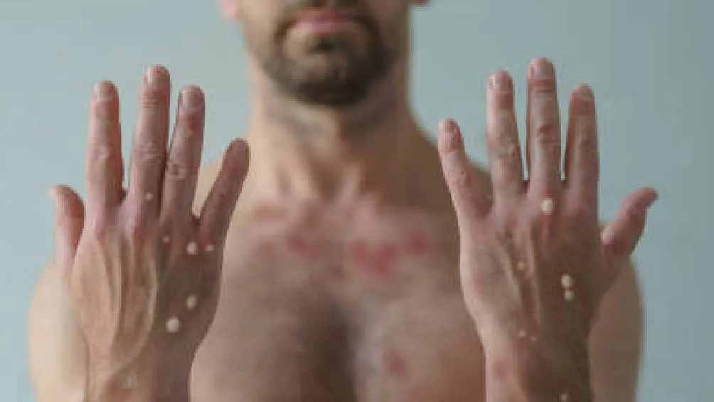 México ha reportado casos en el último mes, ubicándose en el rango de 1 a 99 contagios./ ´Pixabay