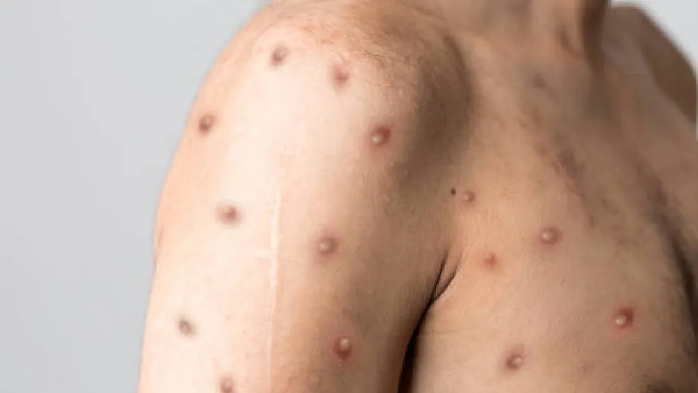 El organismo concluyó que el riesgo de transmisión comunitaria sostenida es alto. / Pixabay