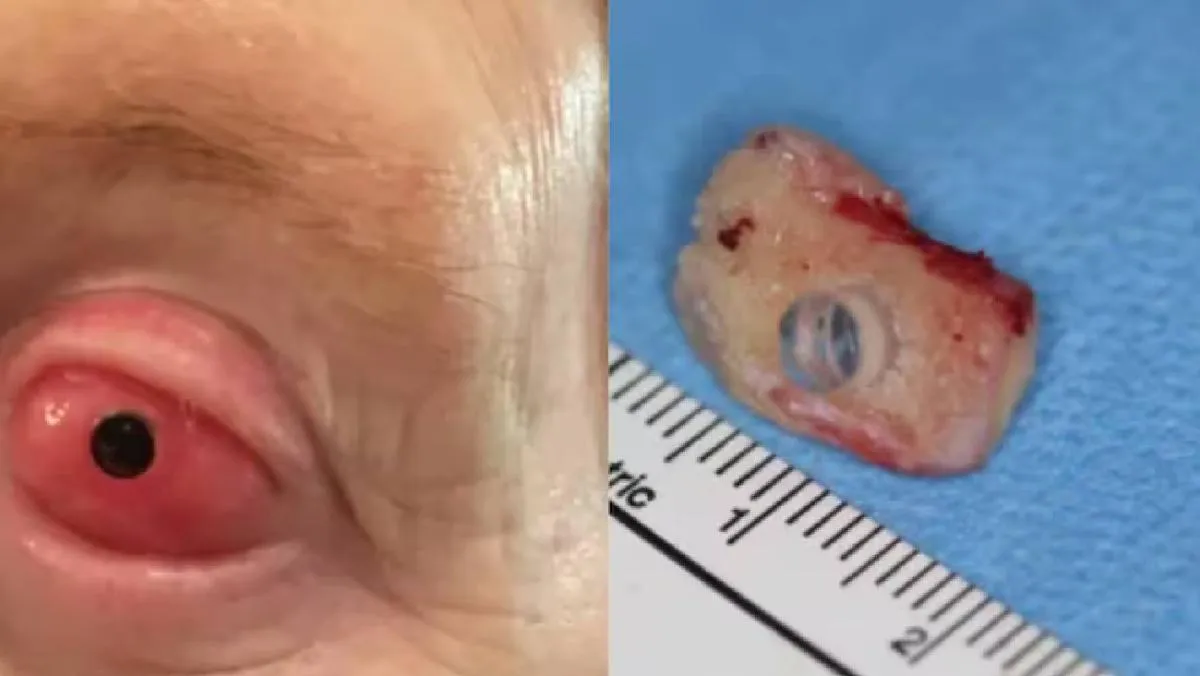 Chapman había perdido la visión a los 13 años debido a una reacción severa al ibuprofeno. / RS