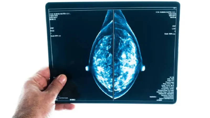 Especialistas enfatizan que el cáncer de mama es la principal causa de muerte por cáncer en mujeres en México. / Pixabay