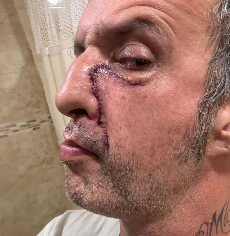 Así se vió su cara tras su primera operación de las 12 que se realizó / IG: @titof