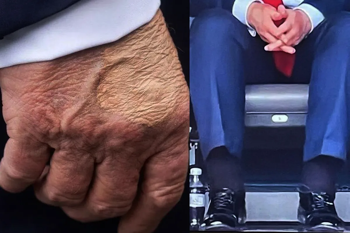 La insuficiencia venosa crónica es lo que afecta a Trump en manos y piernas / Redes Sociales