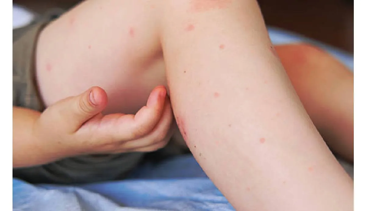 La chikungunya es una enfermedad viral que causa fiebre alta, erupciones cutáneas, fatiga y dolor articular severo | iStock