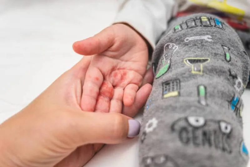 El brote de virus Coxsackie recuerda la importancia de la prevención, la higiene y la vigilancia en niños | iStock