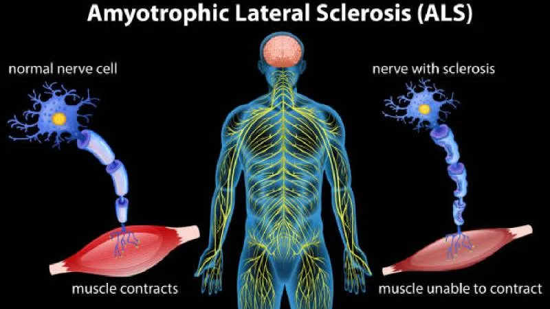 ELA es una enfermedad incurable que va minando la salud del paciente/Pixabay