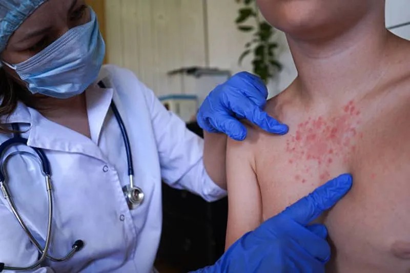 Durante diciembre se registra un aumento de casos de sarampión en el país/Pixabay