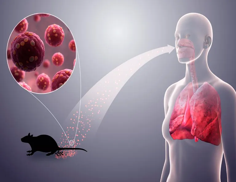 La enfermedad que terminó con la vida de Hackman / ADALnet