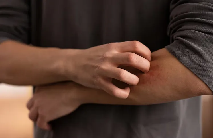 La persona contagiada empezó con los síntomas del gusano / FREEPIK