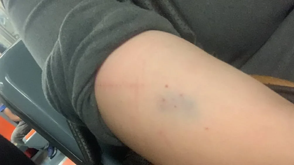 La joven compartió una foto donde se observan cuatro marcas en su brazo/X