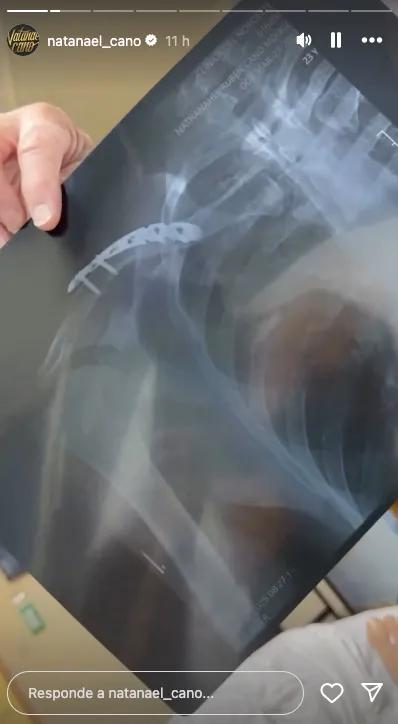 Natanel Cano se rompió la clavícula tras la caída / IG: @natanael_cano