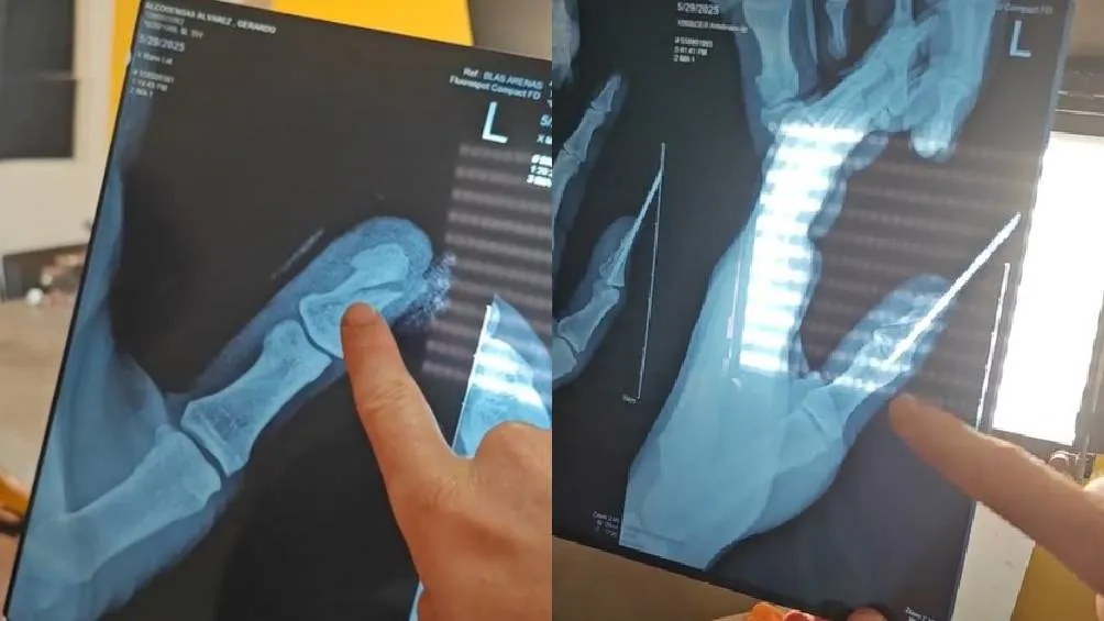 El dedo de Jimmy se partió en dos, teniéndole que colocar un tortillo para su recuperación/IG: @pongamoslo_a_prueba