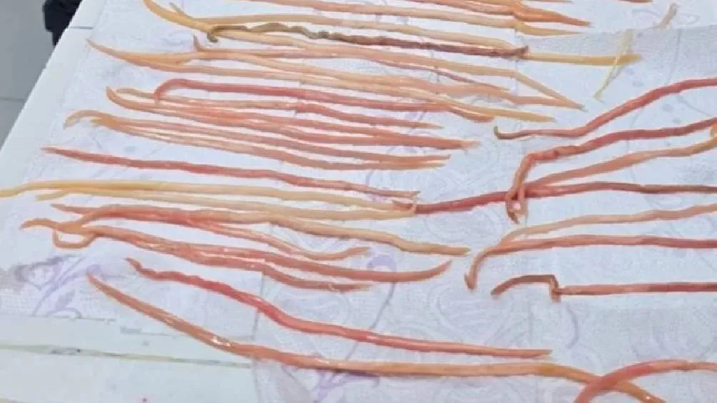 La ascariasis es una enfermedad parasitaria frecuente en áreas rurales con escaso acceso a agua potable y malas condiciones sanitarias./ FB