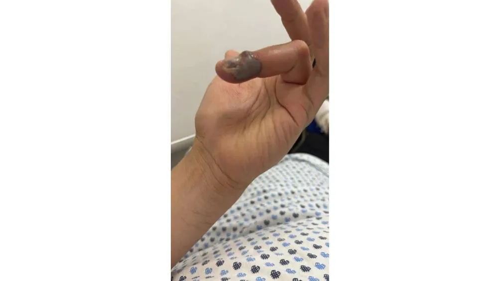 El joven turista pagó 90 mil pesos por el antídoto tras ser picado por una araña.| Captura de pantalla