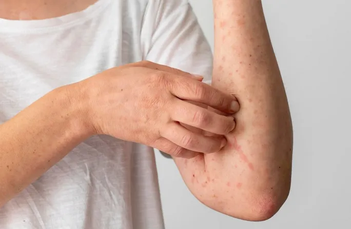 Los casos se sarampión aumentaron en estos meses / FREEPIK