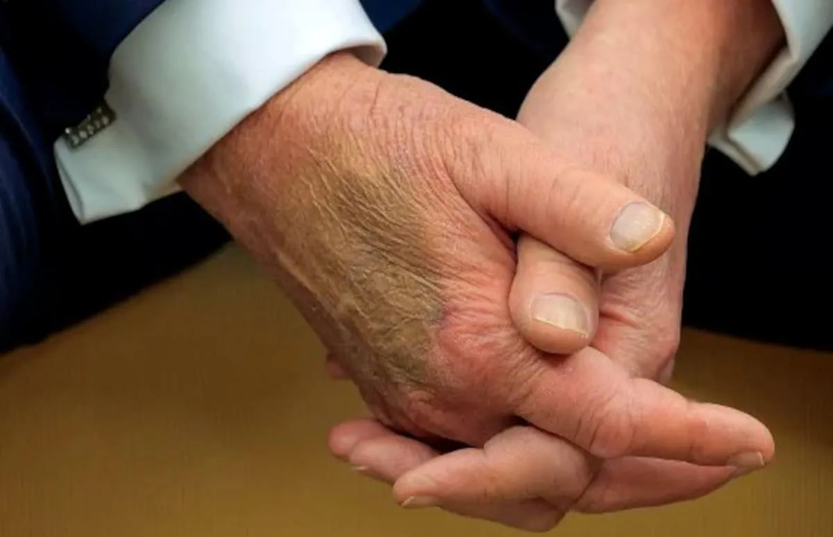 La Casa Blanca explicó la mancha en la mano de Donald Trump / Redes Sociales