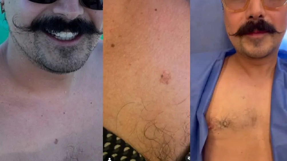 El cáncer de piel salió a relucir mediante un granito en el pecho/IG: @maunieto