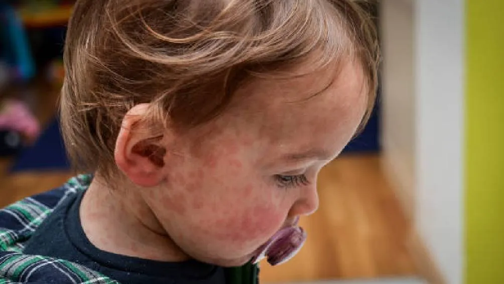 México no registra casos autóctonos desde 1996/iStock