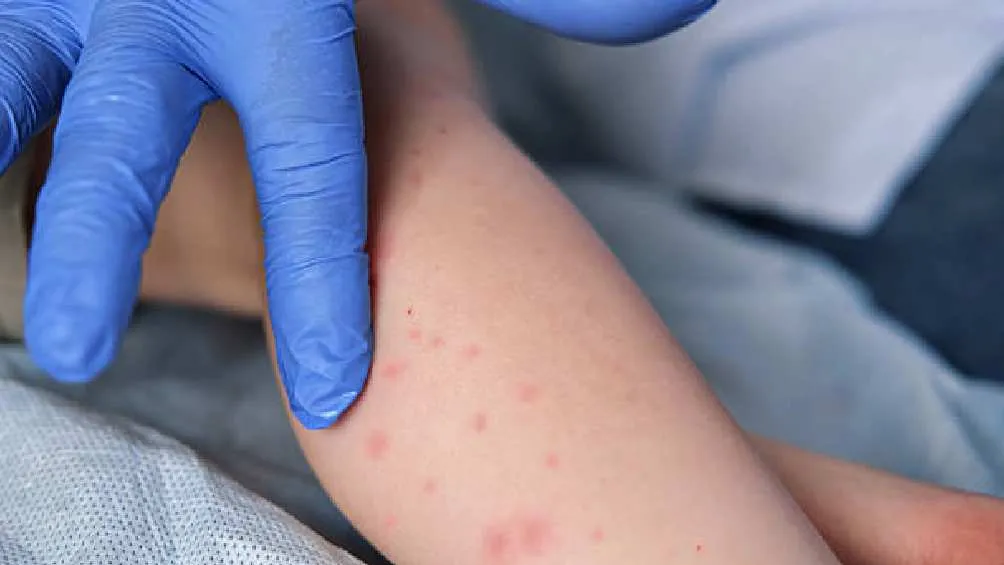 Esta enfermedad se presenta principalmente en menores de edad/Pixabay