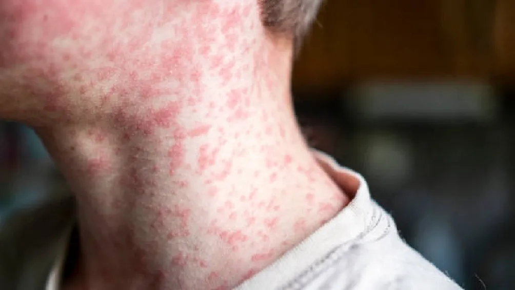 En Estados Unidos se han registrado brotes desde marzo, especialmente en Texas, y se teme que el contagio pueda extenderse si no se toman las medidas adecuadas/iStock