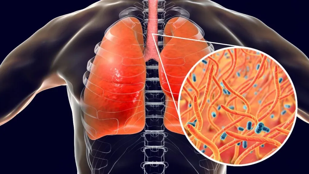 La tos ferina ha tomando la vida de un bebé recientemente en Nuevo León / Redes Sociales