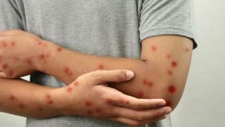 UNAM emite medidas de prevención ante aumento de casos de sarampión en CDMX