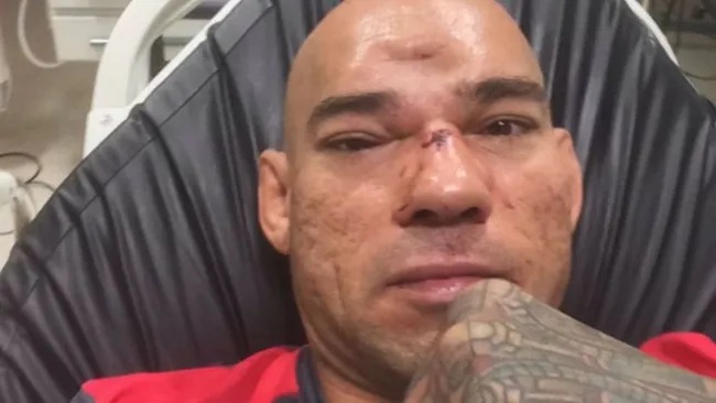 Santos tras fractura en la frente