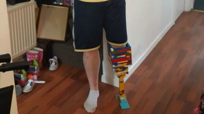 La improvisada prótesis de Legos creada por el británico Marc Cronin