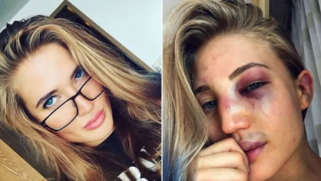 Anastasia Yankova antes y despues de la pelea