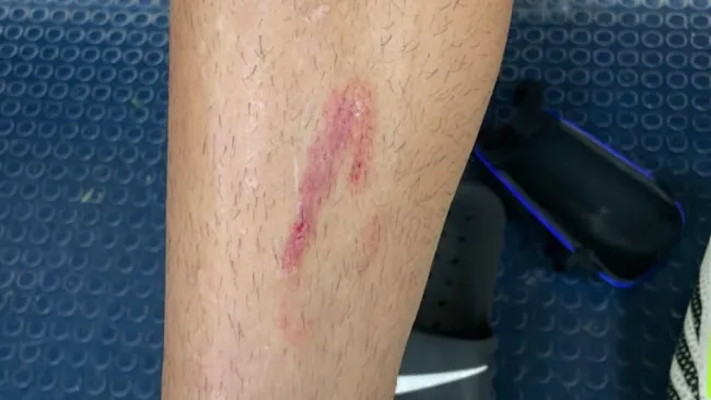 La pierna derecha de Henry Martín 