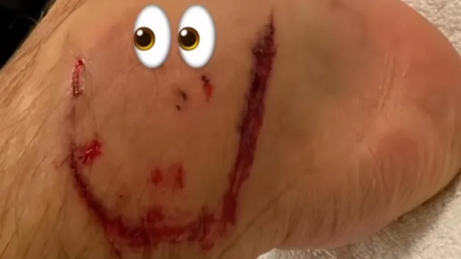 Así quedó el tobillo del alemán 