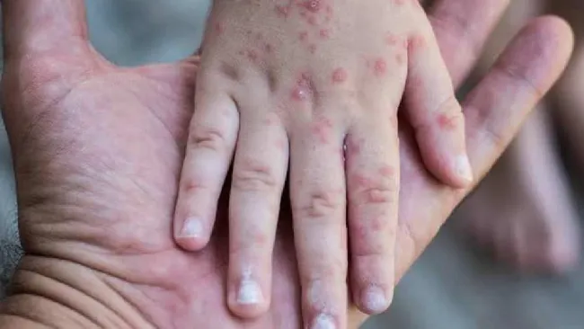 Emiten alerta sanitaria por el virus coxsackie en Hidalgo