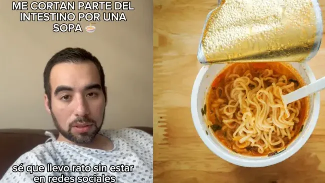 El intestino de un hombre fue cortado por la obstrucción de sopa instantánea