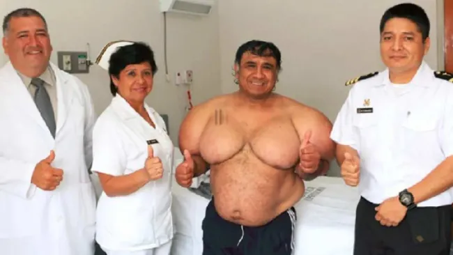 Conoce el caso de Alejandro Ramos, el buzo peruano que vive con el cuerpo 'inflado' 