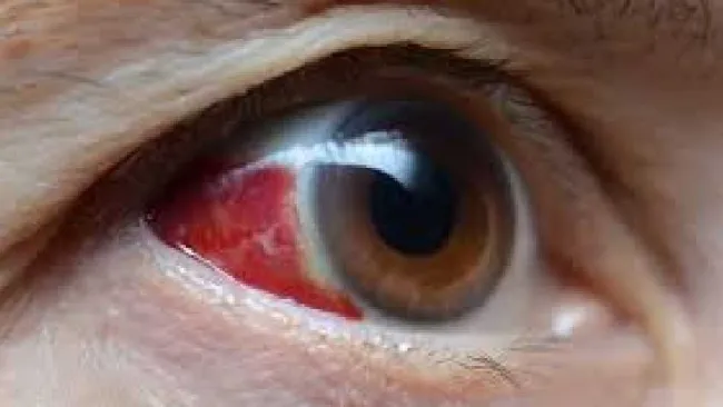 OMS emite alerta sanitaria por virus mortal que provoca sangrado de ojos