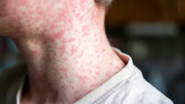 Brote de sarampión en EE.UU. llega a México: lo que debes saber