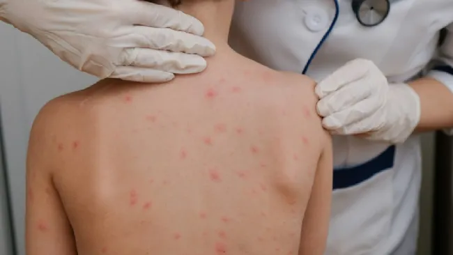 Hasta el momento se reportan mil 520 casos y tres muertes confirmadas en el país.