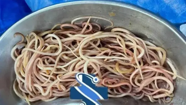 Extraen 142 lombrices intestinales a niño de 7 años en Chiapas