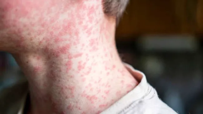 Alertan por brote de sarampión en México: confirman casi 3 mil casos y 9 muertes