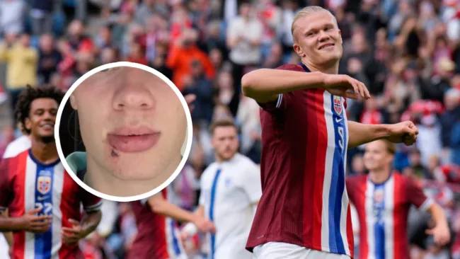 Haaland sufre accidente en autobus y comparte su herida con tres puntos de sutura