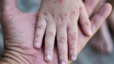 Emiten alerta sanitaria por el virus coxsackie en Hidalgo