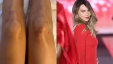 Belinda muestra las heridas que le dejó su caída en desfile de moda