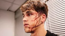 Pau Cubarsi tendrá que jugar con mascara protectora tras golpe en el rostro