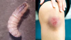 El paciente fue mordido por un perro, pero en la herida se le formaron larvas.