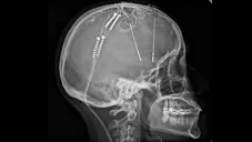 La operación es otra alternativa para combatir este estado mental.