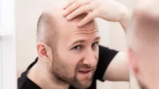 ¿La cura para la calvicie? Científicos de UCLA crean crema que reactiva el crecimiento del cabello