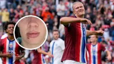 Haaland sufre accidente en autobus y comparte su herida con tres puntos de sutura